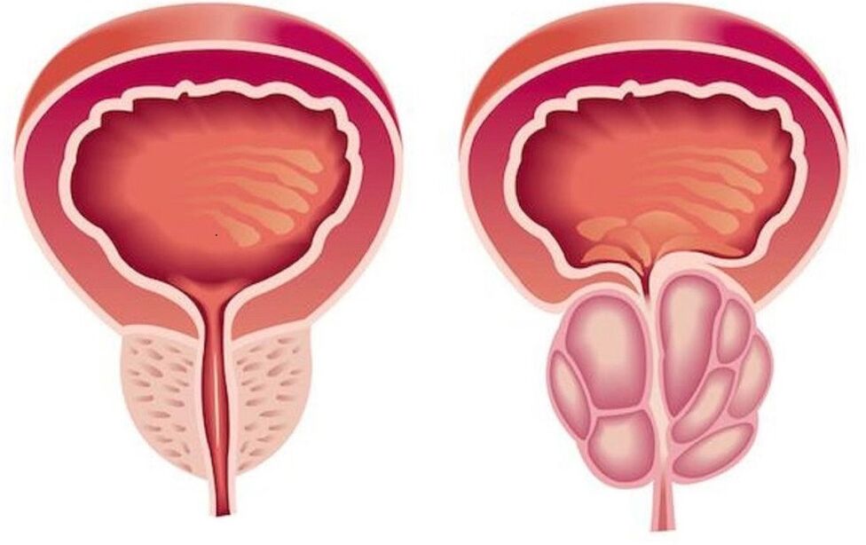 terve ja tulehtunut eturauhanen ja eturauhastulehdus